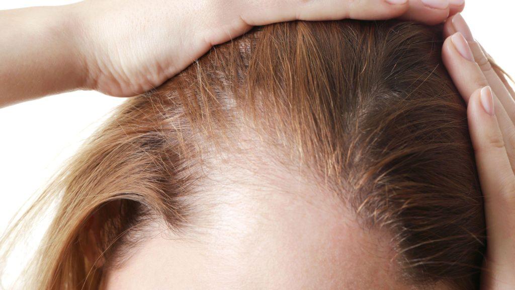 The Harsh Truth About Hair Loss