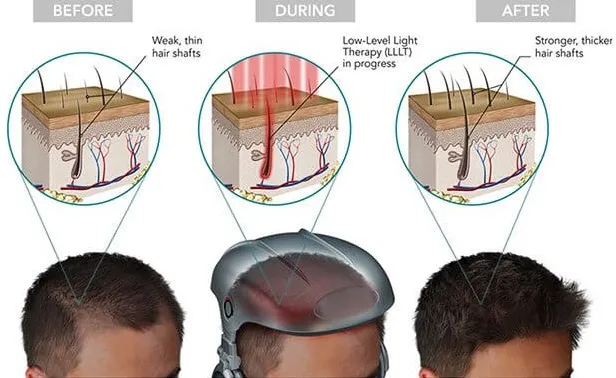 Laser Hair Therapy What to Expect Before, During, and After