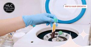 A Guide to Platelet-Rich Plasma (PRP) Therapy for Hair Loss