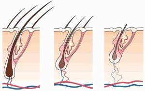 Facts About Pattern Hair Loss