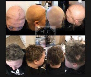 Understanding Alopecia
