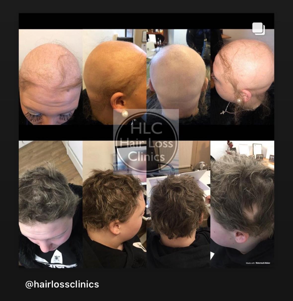 Understanding Alopecia