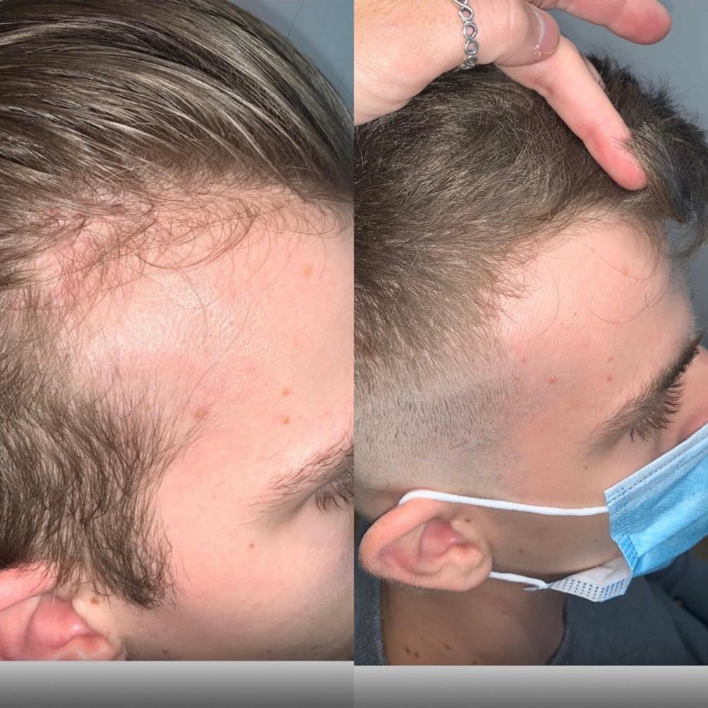 Minoxidil or Laser Hair Therapy