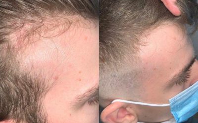 Minoxidil or Laser Hair Therapy