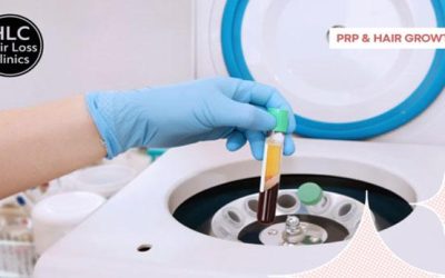 A Guide to Platelet-Rich Plasma (PRP) Therapy for Hair Loss