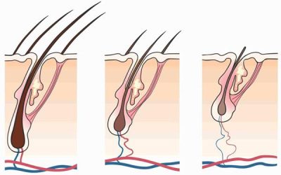 Facts About Pattern Hair Loss
