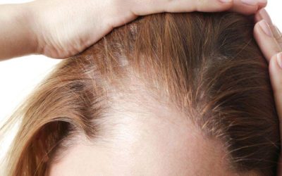 The Harsh Truth About Hair Loss