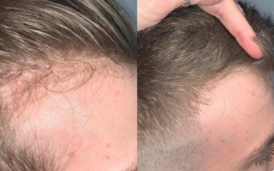 Can You Regrow Hair?